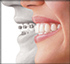 Invisalign Richmond Hill at dentistry in Oak Ridges by Dr. Herzog