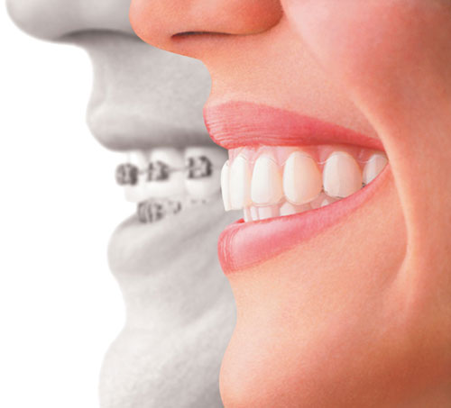 Invisalign (clear aligner therapy) in Richmond Hill at Dentistry in Oak Ridges